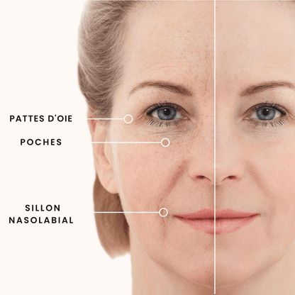 SilkyEyes® - Patchs Micro-Needling Contour des Yeux